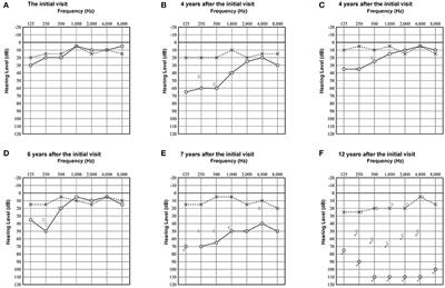 Case report: Concurrent intravestibular schwannoma mimicking Ménière's disease and cochlear hydrops detected via delayed three-dimensional fluid-attenuated inversion recovery magnetic resonance imaging